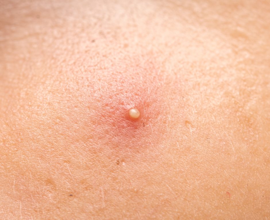 ニキビのパンパンな膿を潰すのはNG！対処法と効果的な薬を解説 | ハダメディア by BIHADADO.TOKYO