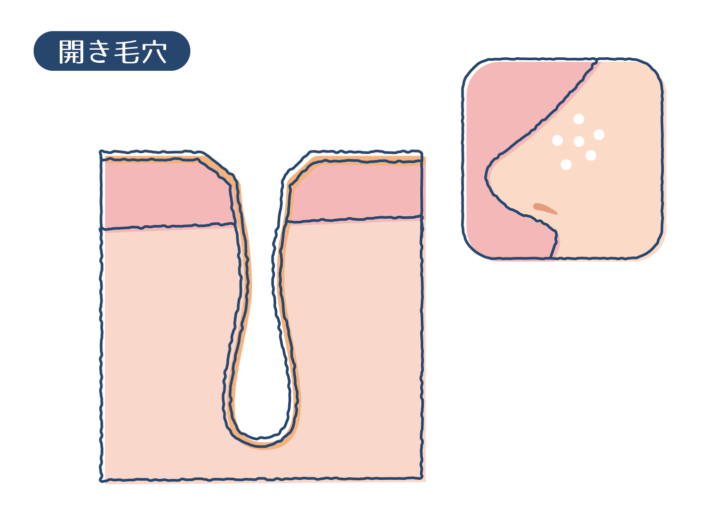 開き毛穴