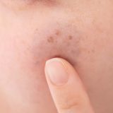 【顔のシミを消す方法】簡単なセルフケアと皮膚科での治療法