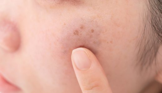 【顔のシミを消す方法】セルフケアできるシミの種類と皮膚科での治療法
