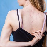 繰り返す「背中ニキビ」は皮膚の病気！正しい治し方を徹底解説