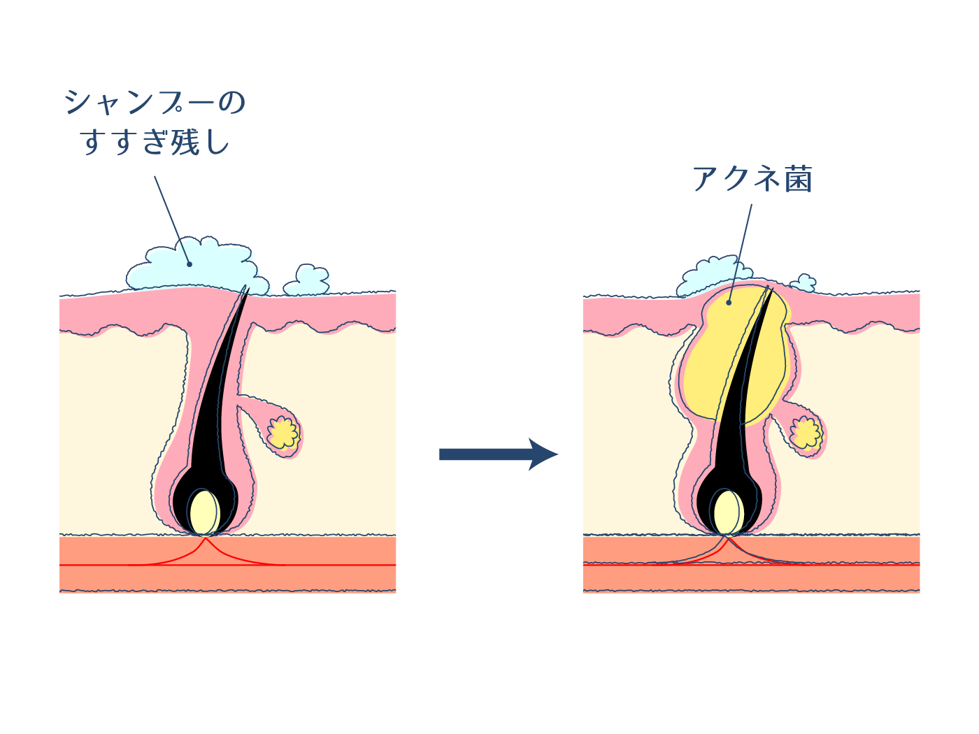 シャンプーのすすぎ残しによりアクネ菌が発生してニキビができる過程