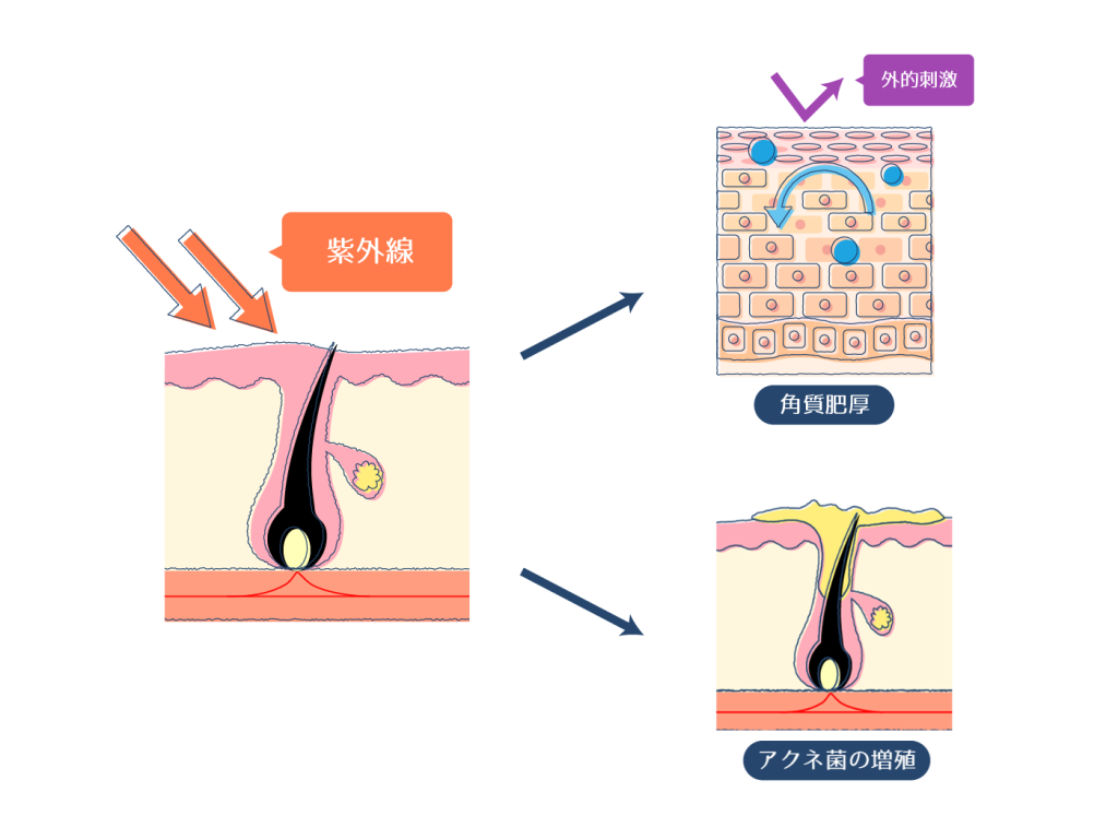 紫外線を浴びて角質肥厚やアクネ菌の増殖が起こる過程を表した画像