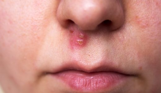「鼻の下のニキビ」の原因を知って正しい対処・悪化防止ケアをしよう！