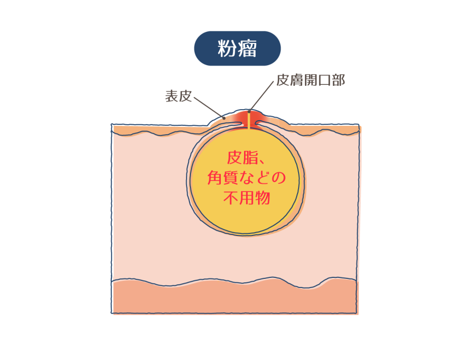 【しこりのあるニキビの治し方】粉瘤との違いや見分け方を解説! | ハダメディア by BIHADADO.TOKYO