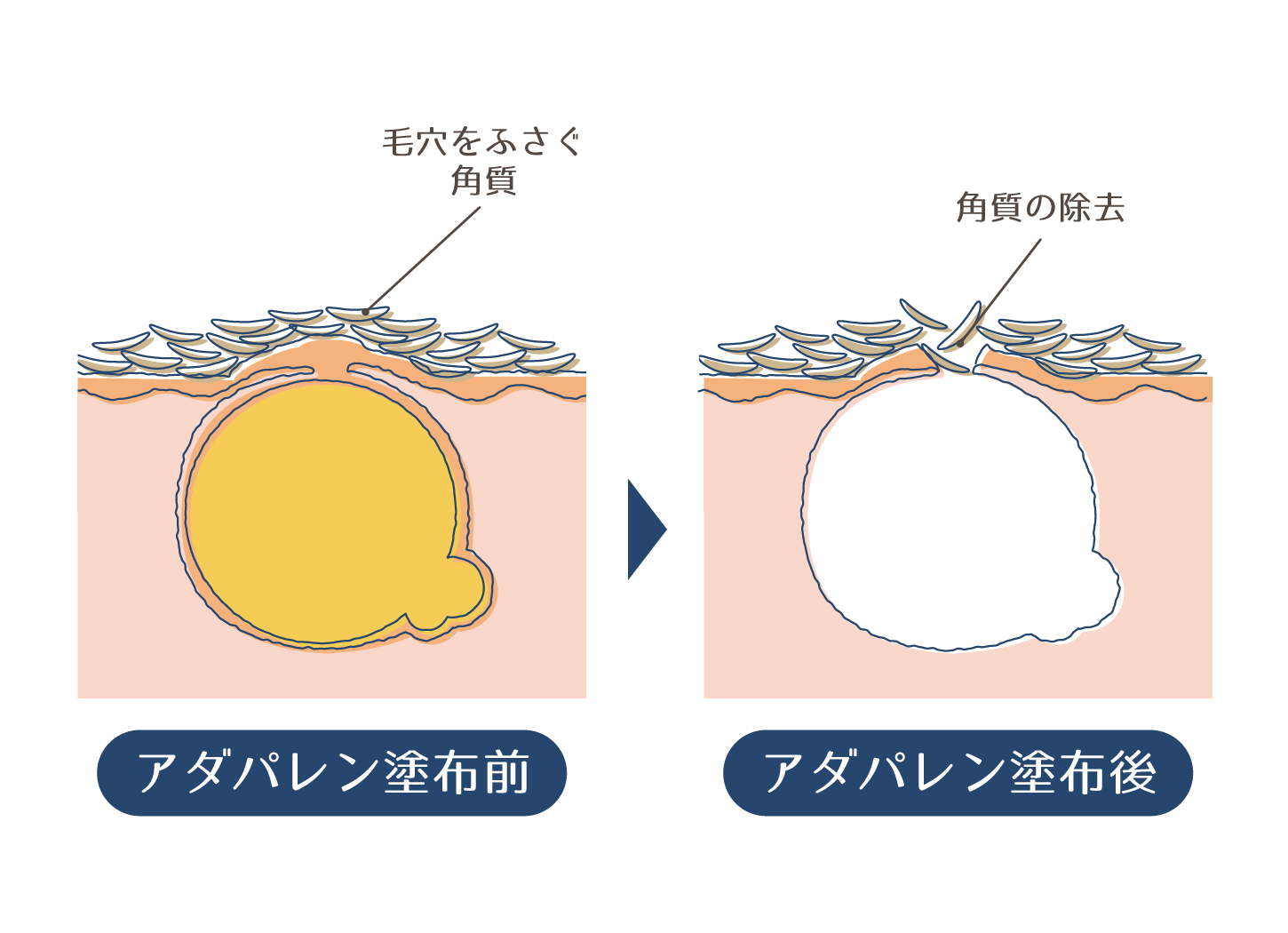 アダパレンの効果のイメージイラスト