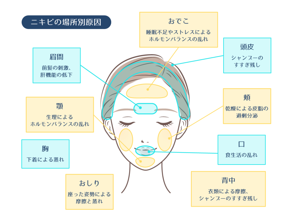 【完全版】ニキビの治し方まとめ！即効性のある対策法と効果的なケア方法 ハダメディア By Bihadado Tokyo