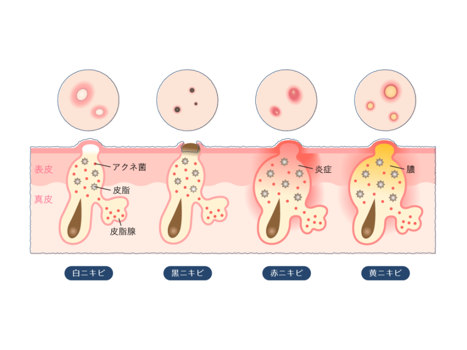鼻の毛穴に詰まった白い塊はニキビ？ニョロニョロの正体や取り方を解説！ | ハダメディア by BIHADADO.TOKYO