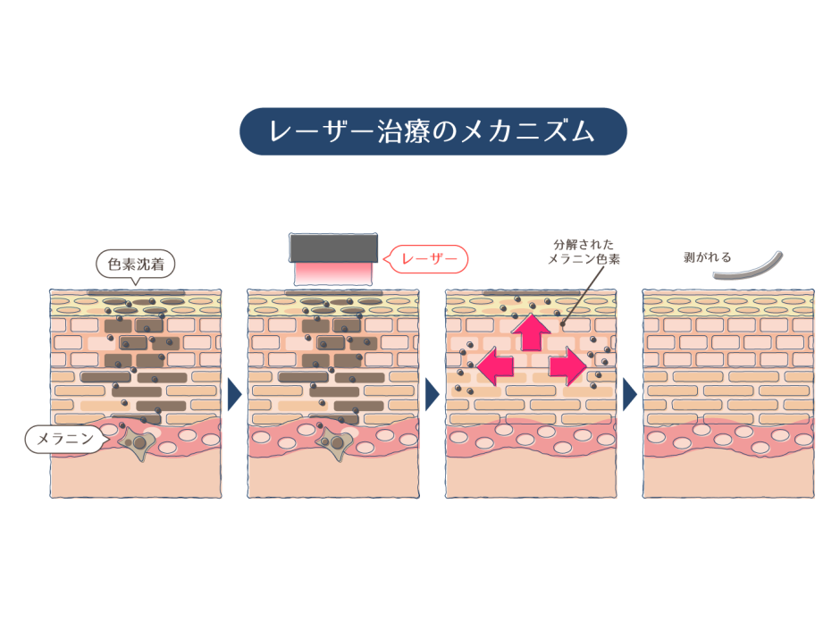 シミの種類と見分け方！シミの原因と治療法を「画像付き」で解説 | ハダメディア by BIHADADO.TOKYO