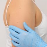 腕のシミは紫外線が主な原因！治療法と自宅でできる改善法まで解説！
