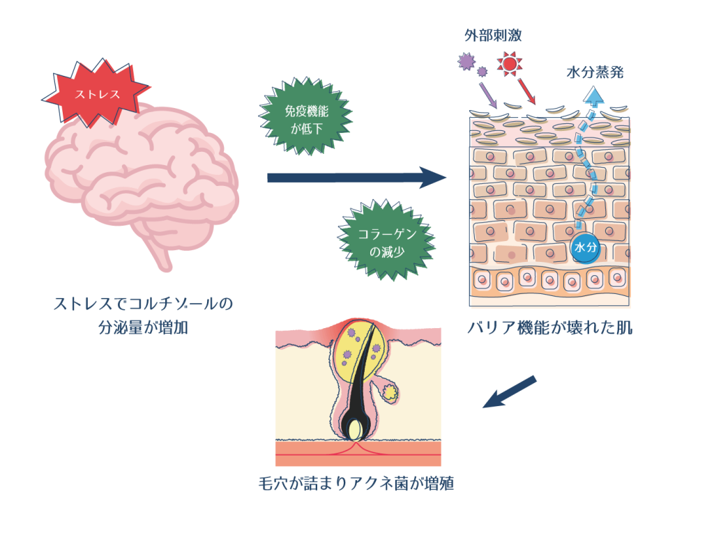ストレスによってバリア機能が壊れてニキビが発生する過程