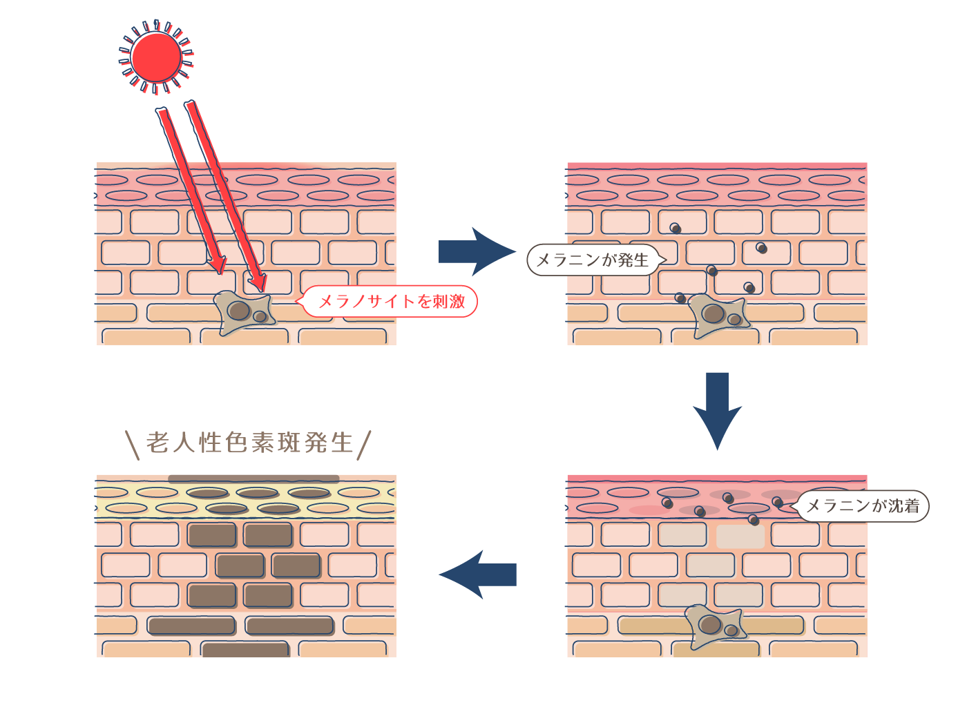 紫外線がメラノサイトを刺激しメラニンが発生することが老人性色素斑の原因