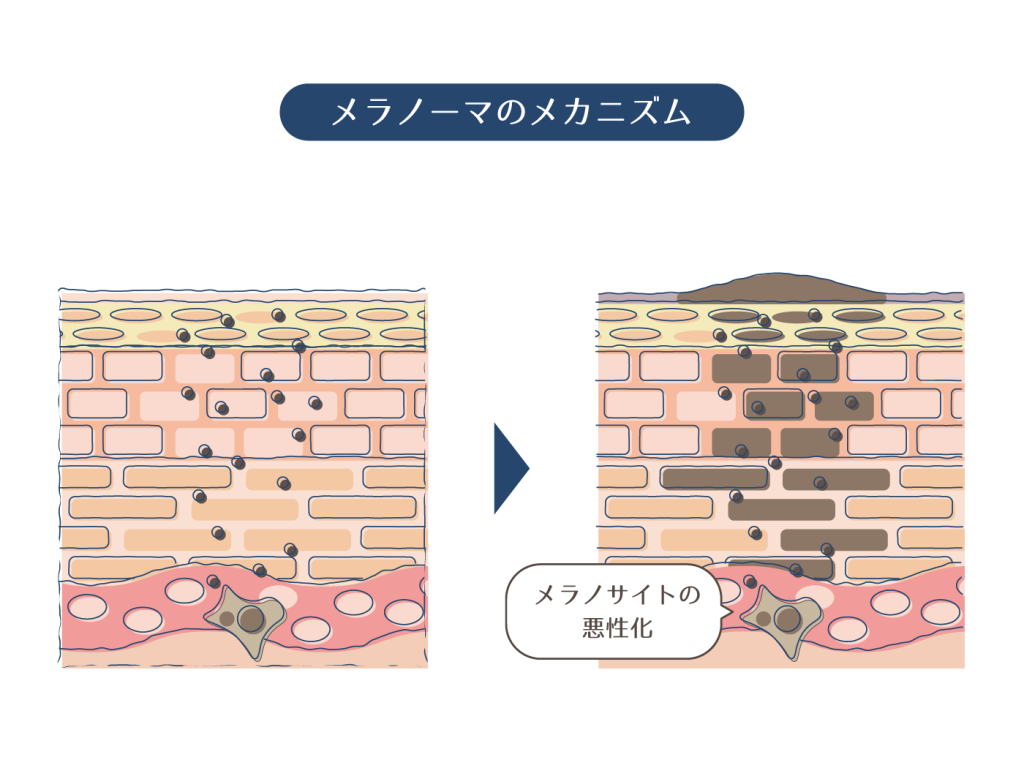 足にできる「茶色いシミ」の原因と治療法を解説！皮膚ガンの可能性も！？ | ハダメディア by BIHADADO.TOKYO