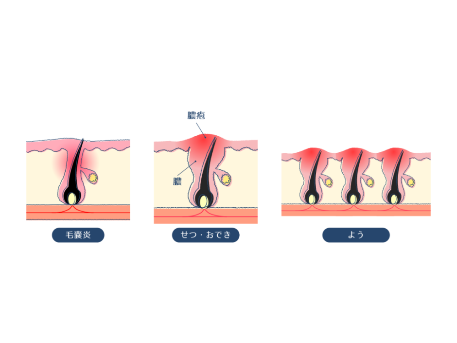 毛穴の炎症の正体は毛嚢炎かも？赤いポツポツ毛穴の治し方を解説 | ハダメディア by BIHADADO.TOKYO