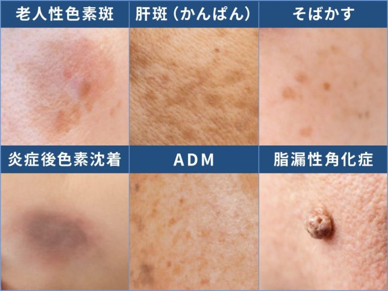 シミの種類と見分け方！シミの原因と治療法を「画像付き」で解説 | ハダメディア by BIHADADO.TOKYO