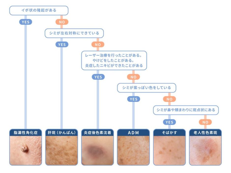 シミの種類と見分け方！シミの原因と治療法を「画像付き」で解説 | ハダメディア by BIHADADO.TOKYO