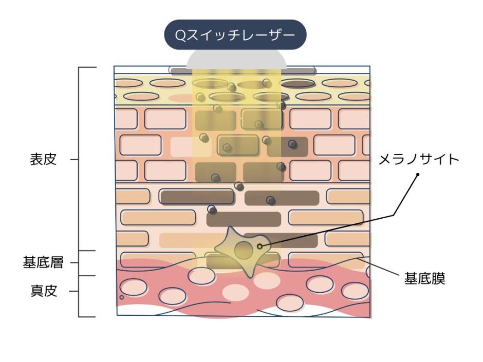 シミの種類と見分け方！シミの原因と治療法を「画像付き」で解説 | ハダメディア by BIHADADO.TOKYO