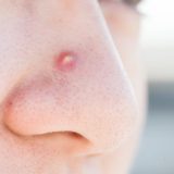 鼻のニキビの原因とは？赤くて痛い鼻ニキビを即効治す方法