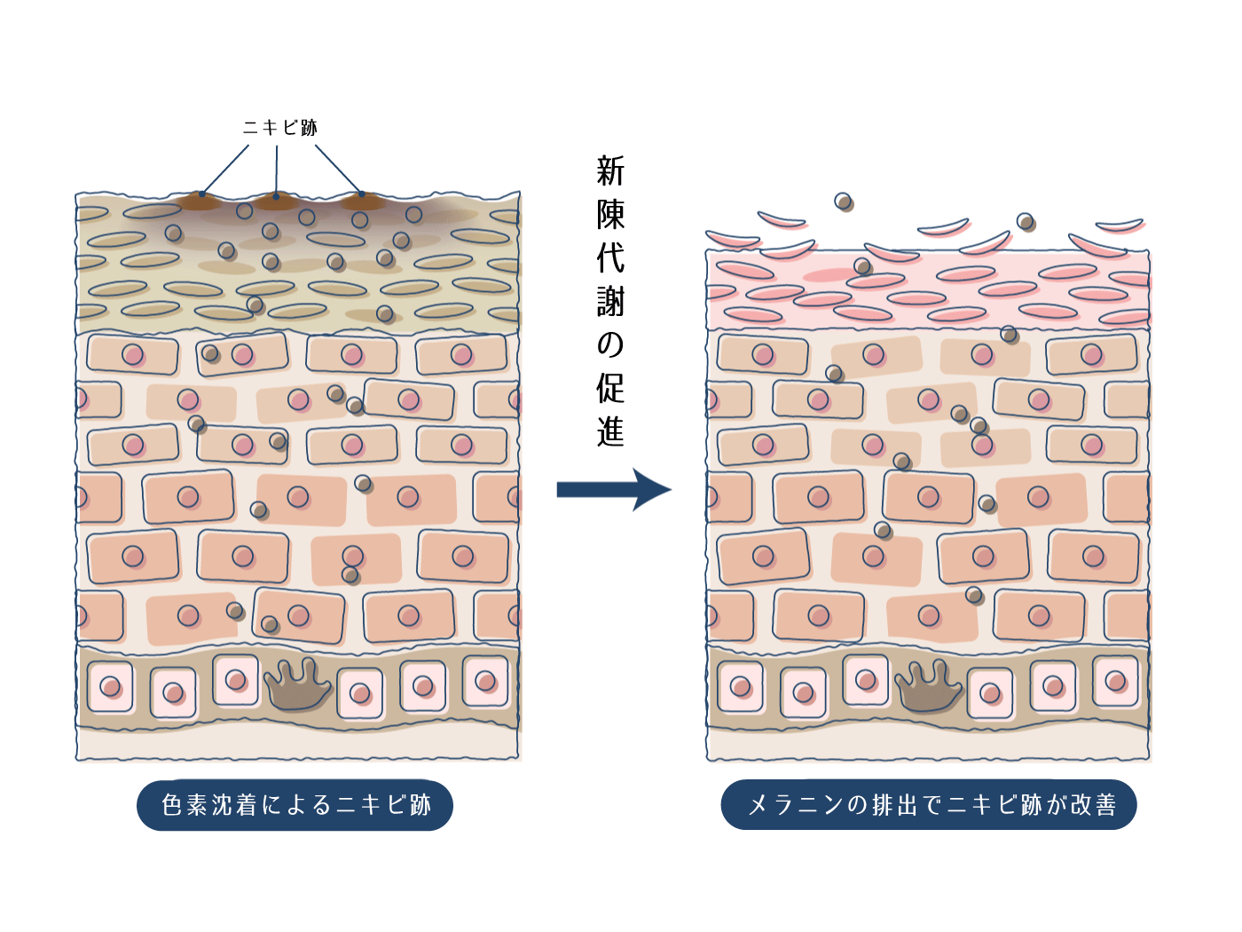 ユベラが作用してニキビ跡を改善していることを表した画像