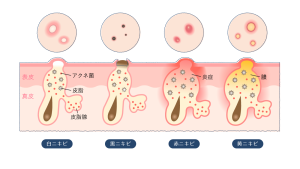 白ニキビは潰していい?潰すと早く治る?潰した後の対処法も解説 | ハダメディア by BIHADADO.TOKYO