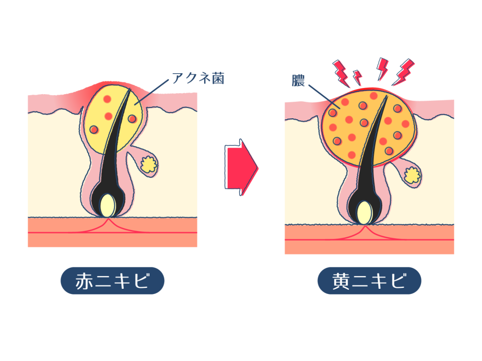 臭いニキビは実は粉瘤？膿を潰した時の悪臭の原因や治し方を紹介 | ハダメディア by BIHADADO.TOKYO