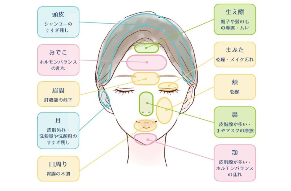 顔にニキビができるのは何故？場所で変わる原因と治し方を解説 | ハダメディア by BIHADADO.TOKYO
