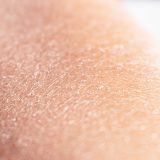 肌の乾燥とはどんな症状？かゆみや粉吹きの原因や改善方法をご紹介