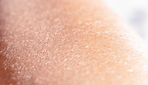 肌の乾燥とはどんな症状？かゆみや粉吹きの原因や改善方法をご紹介