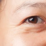 目の下のたるみの原因とは？自力で治す方法や皮膚科での治療を徹底解説！