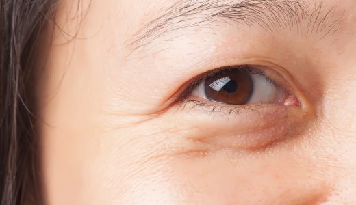 目の下のたるみの原因とは？自力で治す方法や皮膚科での治療を徹底解説！