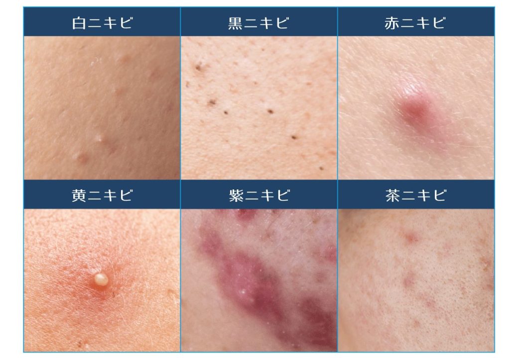 「ニキビの種類」を画像付きで解説！症状の違いや原因を知って効果的に治そう | ハダメディア by BIHADADO.TOKYO