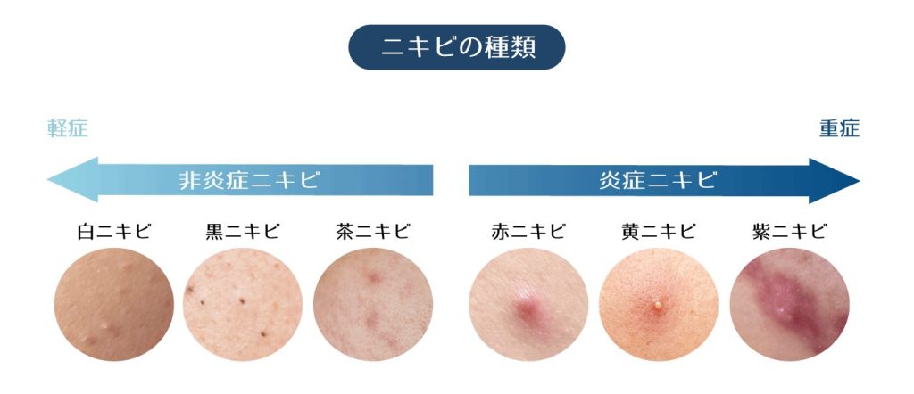 Illustration representing vitamin D’s subtle but essential role in infant growth