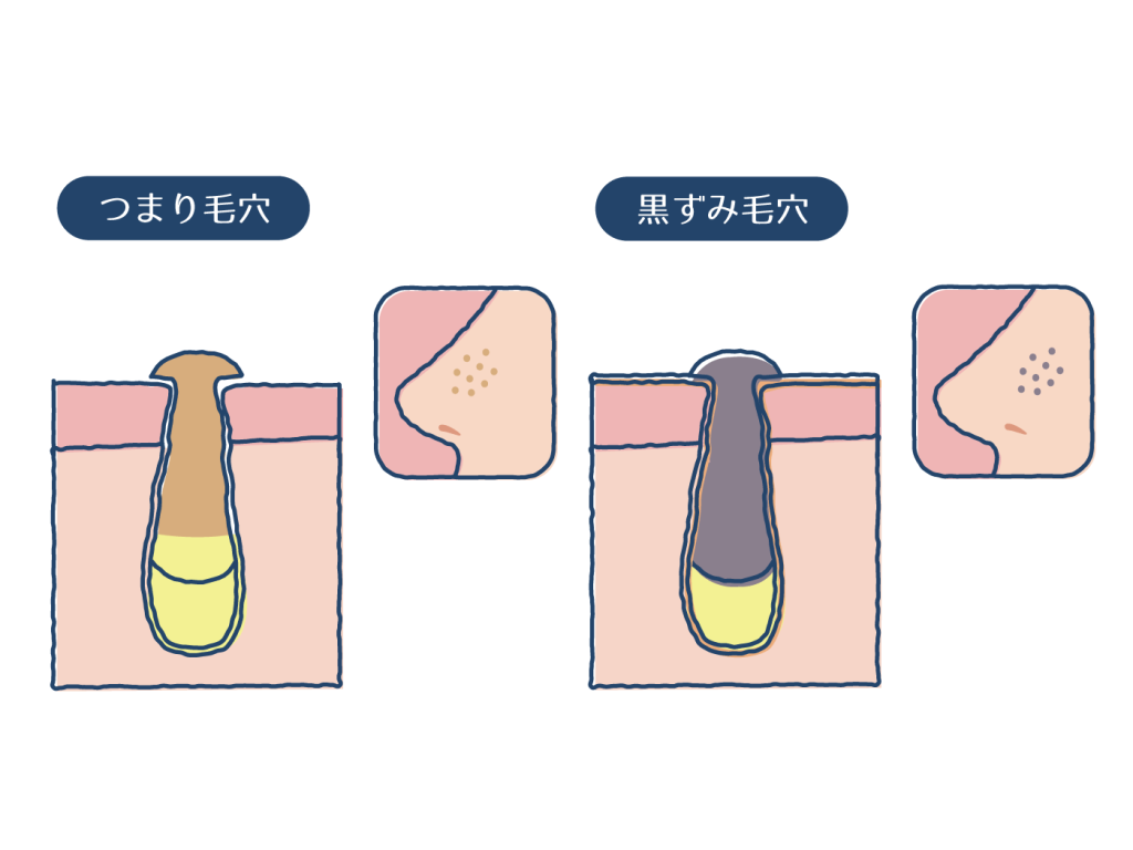角栓の正体とは?効果的なスキンケアと皮膚科での除去方法を解説 | ハダメディア by BIHADADO.TOKYO