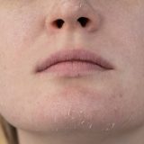 顔の皮膚がポロポロむけるのは何の病気？かゆみ・赤みの原因と対処法を解説！