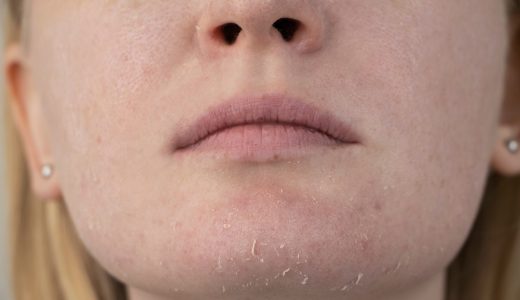 顔の皮膚がポロポロむけるのは何の病気？かゆみ・赤みの原因と対処法を解説！