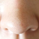 いちご鼻の治し方を解説！家にあるものでできるケアや即効性を期待できる施術を紹介