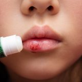 唇が乾燥しやすい原因とリップクリームや医薬品によるケア方法を解説！