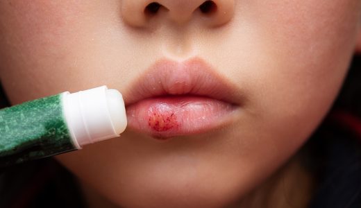 唇が乾燥しやすい原因とリップクリームや医薬品によるケア方法を解説！