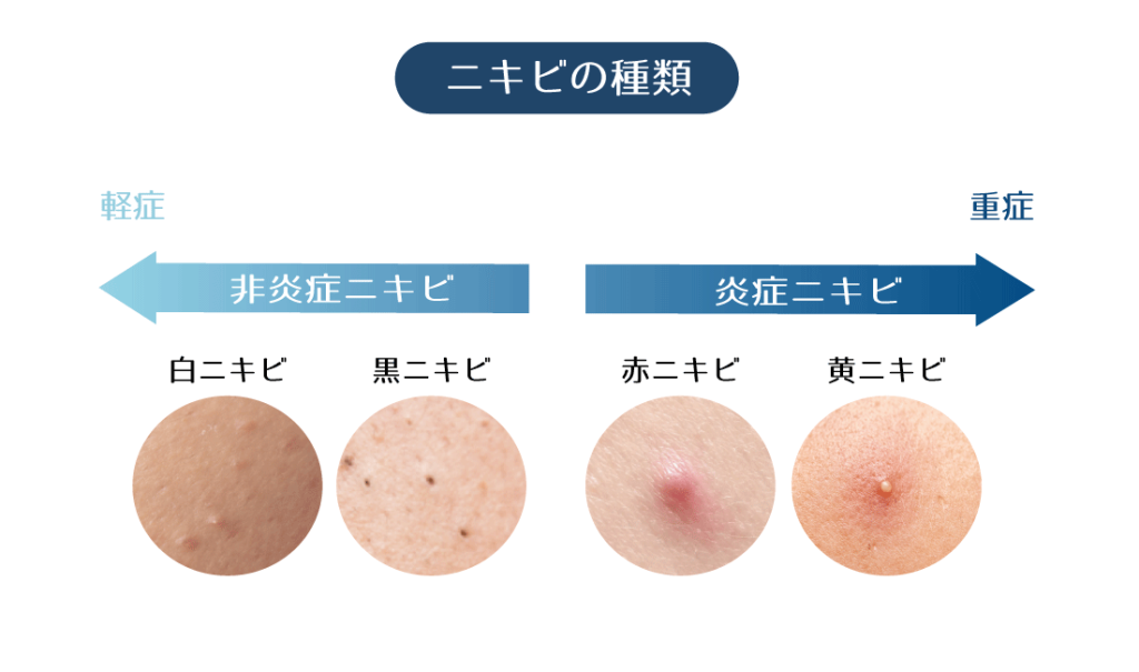 白・黒・赤・黄ニキビのイメージ図が載っている画像