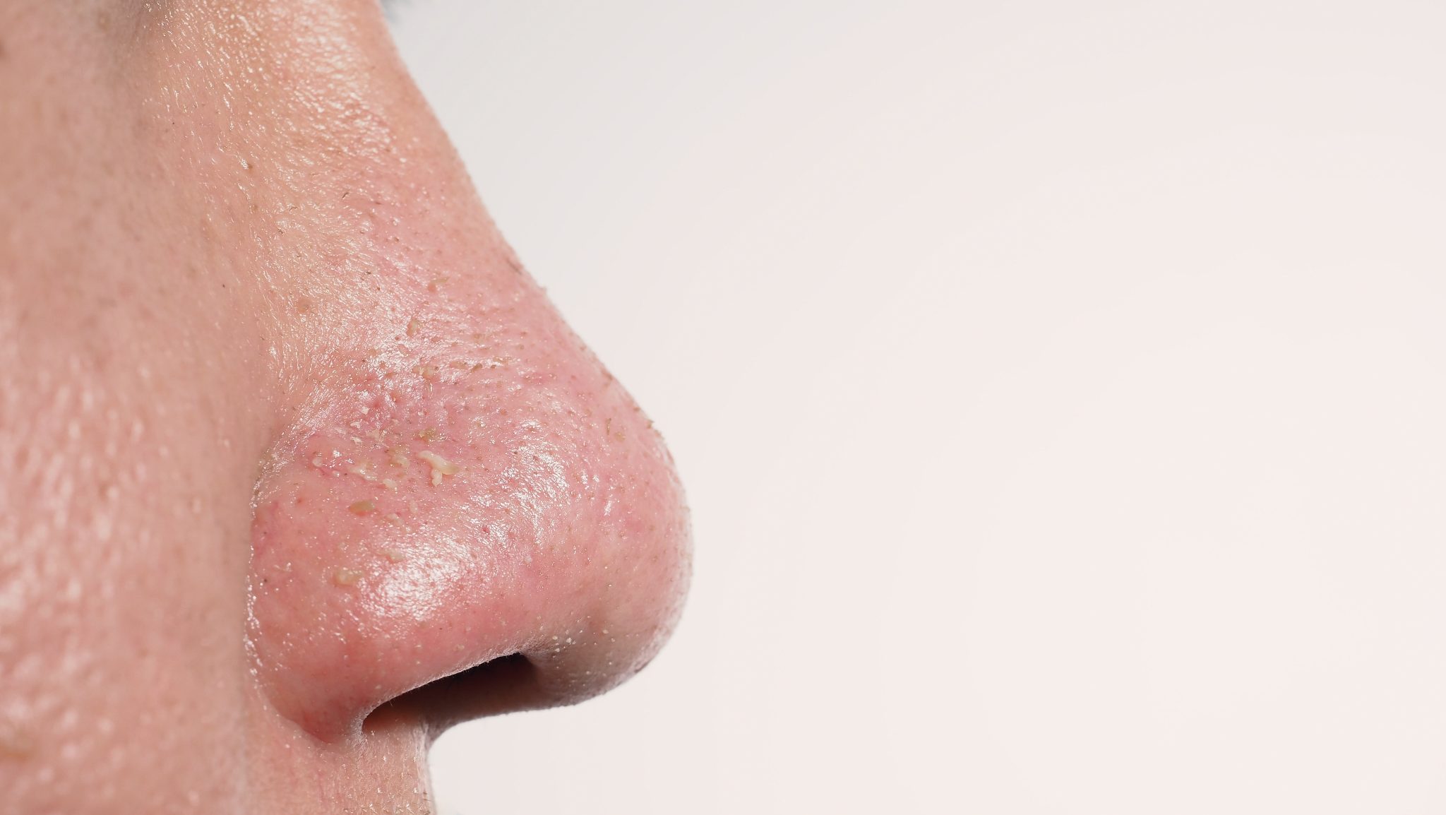 角栓がない人の特徴とは?顔や鼻の角栓を改善する方法を徹底解説 | ハダメディア by BIHADADO.TOKYO