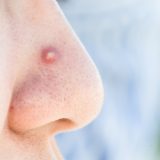 鼻の横のニキビの治し方を解説！痛みを伴う場合の対処法や予防法もご紹介