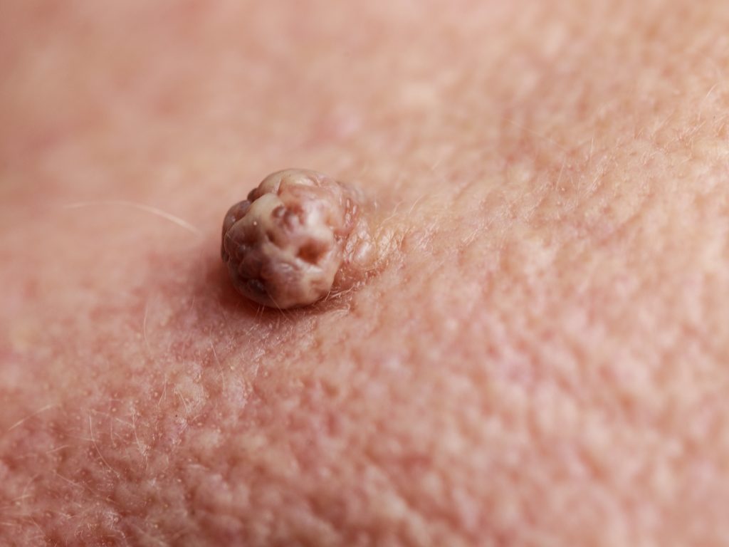 脂漏性角化症ができた肌の写真