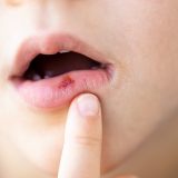 唇のシミの原因と自力で消す方法を解説！ほくろとの見分け方やレーザー除去法も紹介