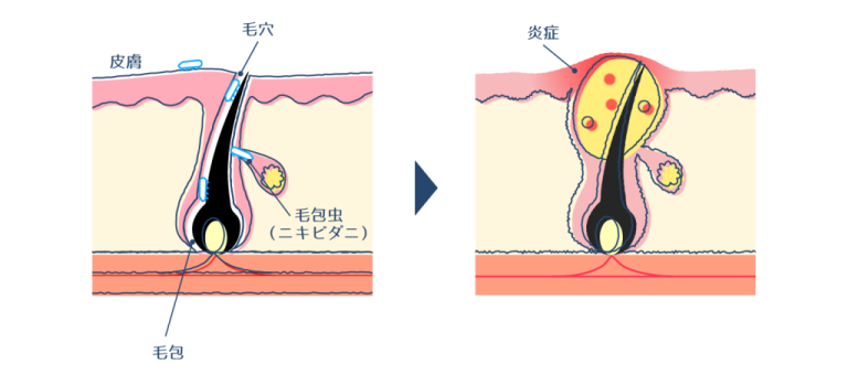 顔ダニによる症状を改善!ニキビとの見分け方や対処法まで解説! | ハダメディア by BIHADADO.TOKYO