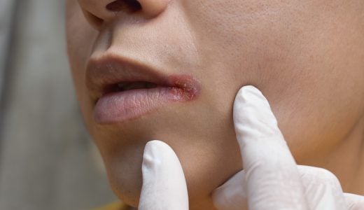 口周りが乾燥する原因を解説！皮がむける・粉吹きなど症状別の対処法も紹介