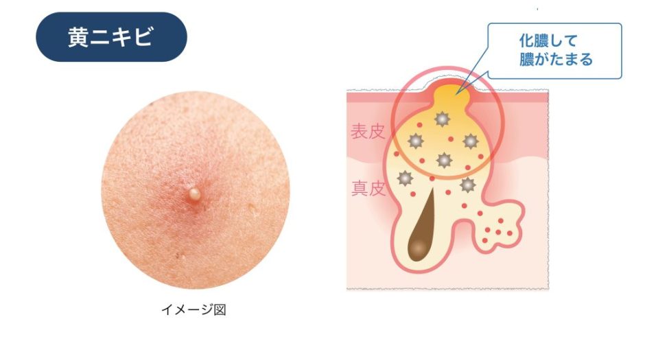 ニキビの薬は皮膚科でもらうべき？症状別の処方例と各効果を解説 | ハダメディア by BIHADADO.TOKYO