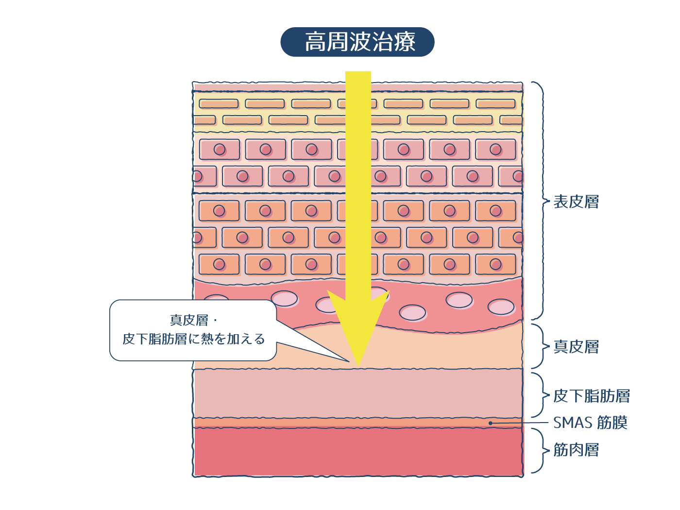 高周波治療のメカニズム画像