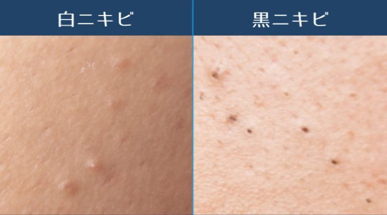 ニキビケアにおすすめの石鹸を紹介!肌質別の選び方を解説 | ハダメディア by BIHADADO.TOKYO