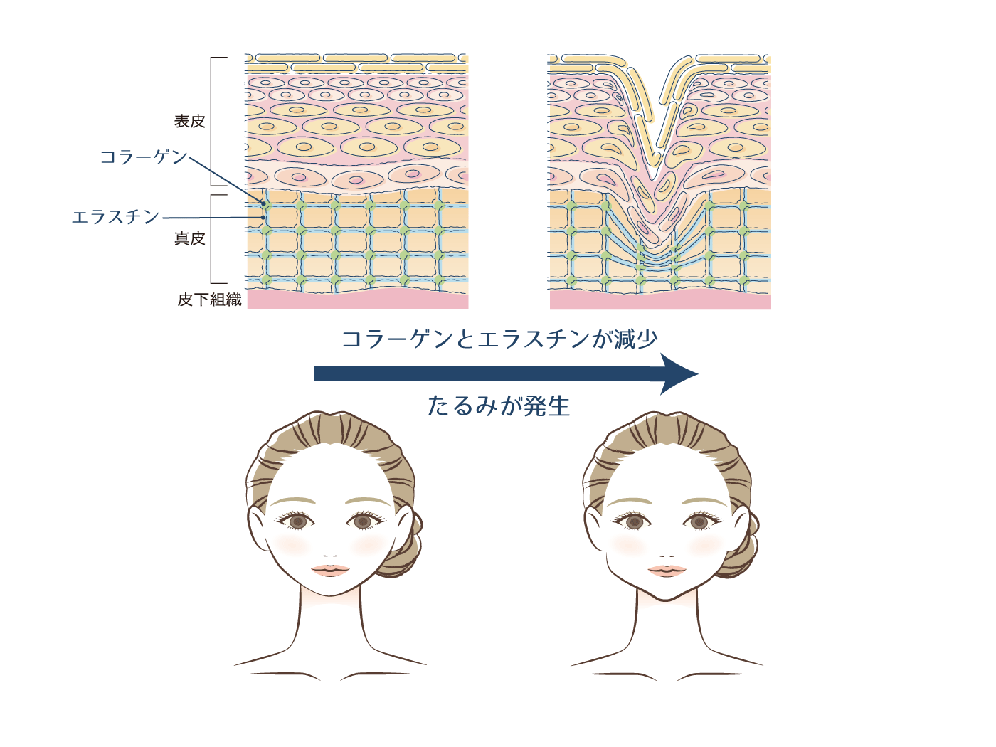 頬のたるみのメカニズム画像