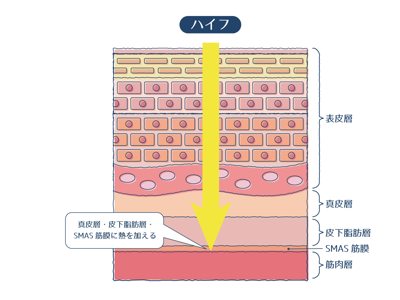 ハイフのメカニズム画像